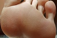 verrue apr�s